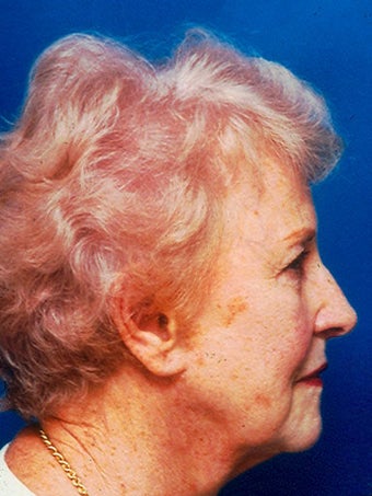 Facelift, Endoscopic Browlift, Upper and Lower Blepharoplasty before 248895