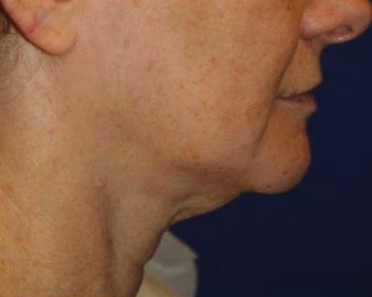 Neck lift surgery before 526353