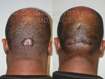 Keloid Removal before 563859