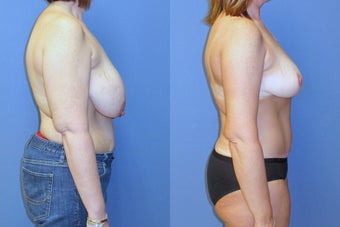 breast reduction and abdominoplasty 579282