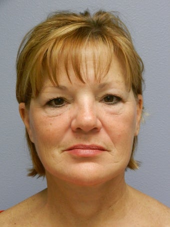 Lower Face Lift with Neck Lift after 608815