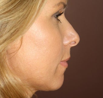 Neck Lift and Upper Eyelid Blepharoplasty after 406795