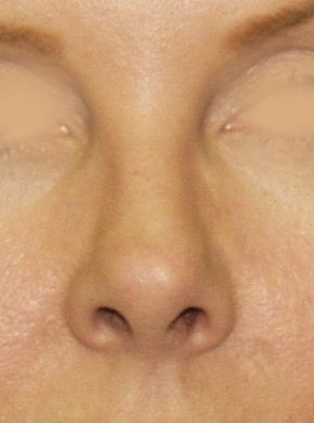 Revision Rhinoplasty before 410624