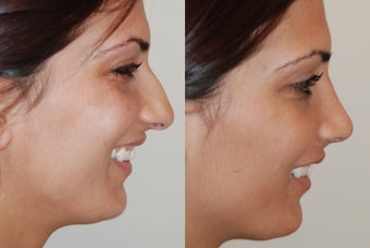 Rhinoplasty Surgery before 206916