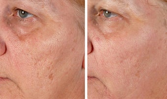 Active FX Fractional Laser Resurfacing before 254011