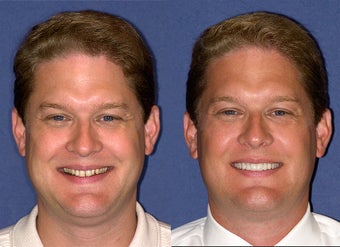 10 Porcelain veneers before 324225