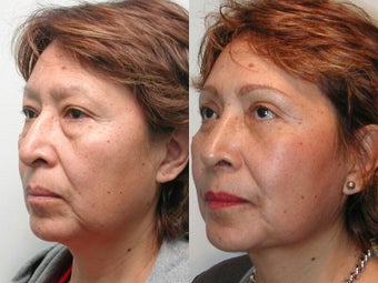 Minifacelift Blepharoplasty before 137735