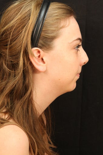 Rhinoplasty with chin augmentation before 248095