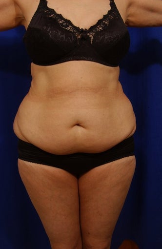 Abdominoplasty with liposculpture of abs, flanks before 82411