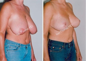 Breast Reduction before 243749