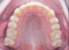 Damon Braces after 379871