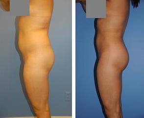 Liposuction before 636194