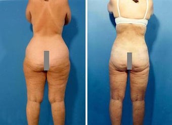 Liposuction before 636253