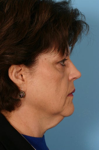 Facelift before 92156