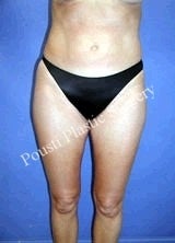 Liposuction before 634646
