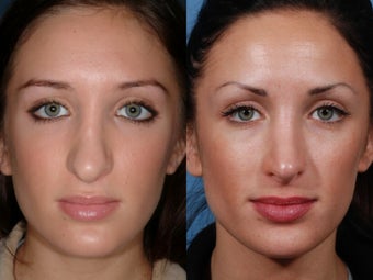 Revision rhinoplasty before 435947