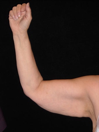 Arm lift (brachioplasty) before 359323