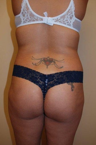 Buttock Augmentation before 534391