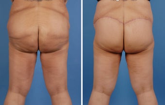 Lower Body Lift and Extended Tummy Tuck 335991