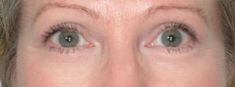 Laser Eyelid Surgery after 369077
