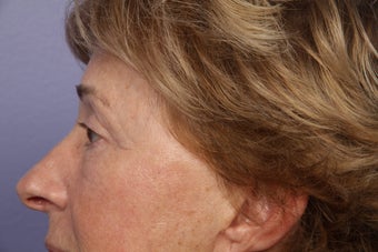 Eyelid Surgery after 306437