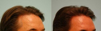 Hair Transplant before 134756