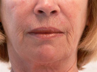 Laser resurfacing before 311932