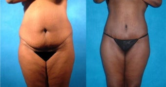 Lower Body Lift with Liposuction and Fat Injections before 101864