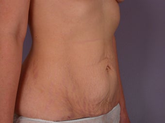 Tummy Tuck before 304985