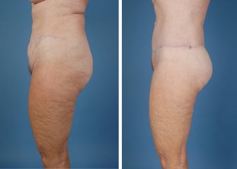 Flank Excision, Abdominoplasty Scar Revision, Liposuction of the Back 303691