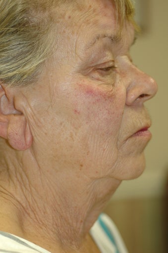 Medically Necessary Ptosis Repair of Both Upper Eyelids, Upper and Lower Cosmetic Eyelid Procedures, Endoscopic Forehead and Mid before 433470