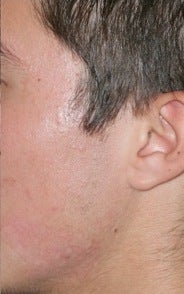 Fraxel Repair for Acne after 374243