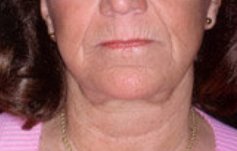 Extreme filler a.k.a liquid facelift before 316574