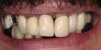Full mouth rehabilitation using 20 implants to restore 28 teeth before 112629