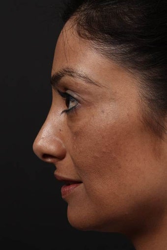 Facial fat grafting 514131