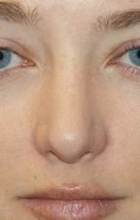 Rhinoplasty after 390972