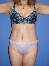 Tummy Tuck Surgery after 122975