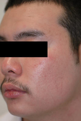 Laser Acne Treatment after 82941