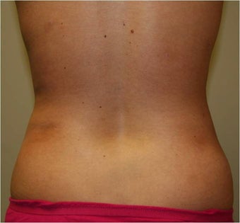 SmartLipo Love Handles Posterior View after 109443