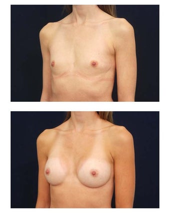 Breast augmentation with silicone implants before 54509