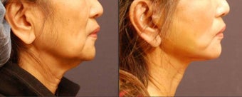 Facelift before 489305
