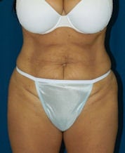 Tummy Tuck before 634288