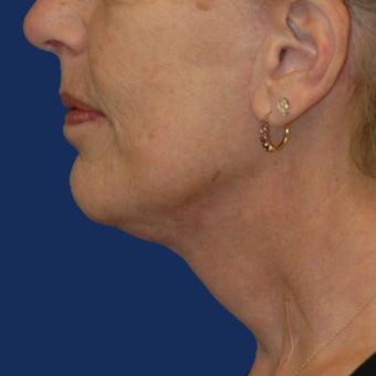 Lower Facelift and Necklift with Platysmaplasty after 243445