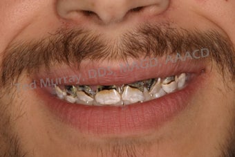 Direct Composite Resin Veneers before 346958