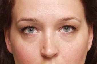 Eyelid Surgery before 118538