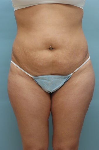 Bikini Tummy Tuck before 243642