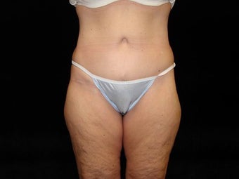 Body Lift with Liposuction of Abdomen, Waist, and Flanks after 203457