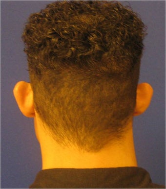 Otoplasty before 302918