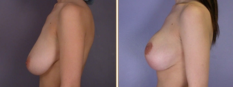 Mastopexy, Breast Lift before 270061
