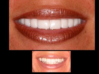 Porcelain veneers before 306847